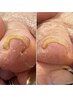 FOOT《巻き爪矯正》ジェルやフットケアと同時施術♪2200/1本