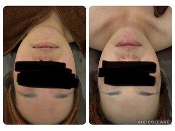 クオーレ(cuore)/レモンボトルビフォーアフター