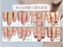 スティラ Stila 678の雰囲気(《深爪矯正》施術写真 https://ameblo.jp/stila678-2021/ )