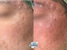 ハーブピーリング&フェイシャルサロン シーベル 福岡天神/症例写真/ハーブピーリング