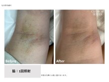 レクリエイター(Re:QREATOR)/セルフ脱毛(before after)