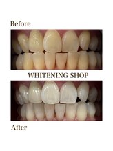 ホワイトニングショップ 恵比寿店/【Before　After】