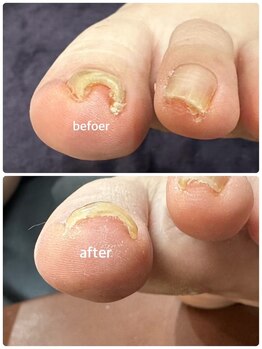 ゾゾ イリプレッセブル(ZOZO irreplaceable)/巻き爪