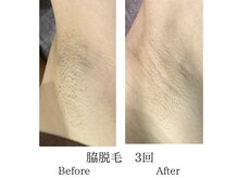 ミーシェ(Meshie)/両脇脱毛　施術前後