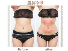 モテスリム/脂肪冷却 お腹2カップ