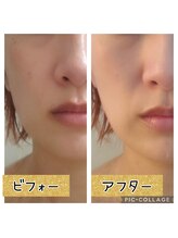 ハナ(HANA)/お顔引き上げ、くすみ撃退