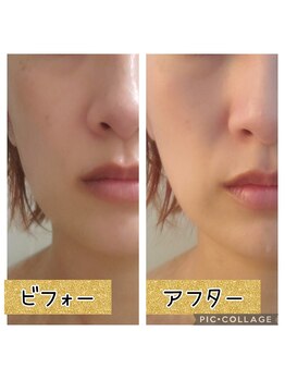 ハナ(HANA)/お顔引き上げ、くすみ撃退