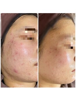 おうちサロン ミキ/繰り返すニキビケア、赤みに◎