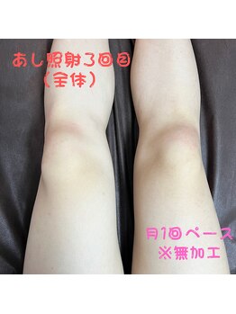 フェリッセ(FELISSE)/あし脱毛 照射3回目【M様】