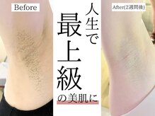 イーサム(e-sam)/完全都度払い×痛み最小限の脱毛