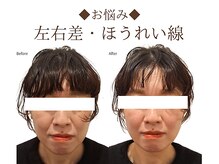 レジスタ(REGISTA)/【小顔矯正】before/after