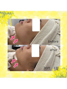 グラシア(gracia)の写真/【エステ版ポテンツァ×レモンボトル】渡韓せずに本場の施術を！千歳初☆結果重視の方必見♪