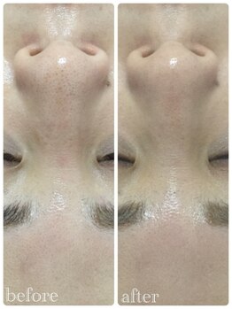 メイユール(MEILLEUR)/光フェイシャル1回