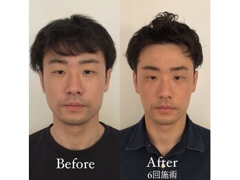 コルミチョン サロン(骨美整 salon)/Before・After &nbsp;6回施術