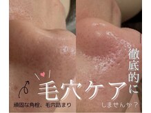 アムリリー 南草津店(AMRILY)/ハイドラ水素毛穴洗浄