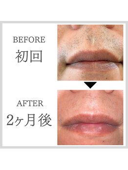 エクレ 今池店(EKURE)/ヒゲ脱毛