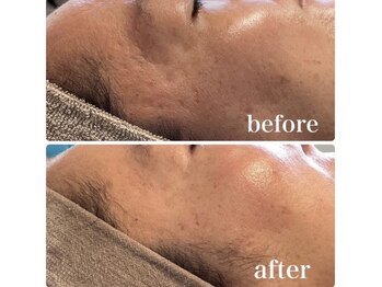 レア(Lea)/赤ら顔にもおすすめ