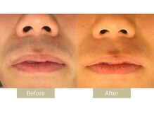 リフサロ(Rifsaro)/ヒゲ脱毛6回 Before/After