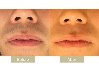 リフサロ(Rifsaro)/ヒゲ脱毛6回 Before/After