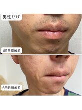 セルフ脱毛サロン　SELFMADE イオンタウン仙台泉大沢店【3/29 NEW OPEN（予定）】 /【ビフォーアフター】セルフ脱毛