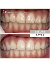 イージーホワイトニング 神戸三宮店(easy whitening)/お客様の症例写真です★