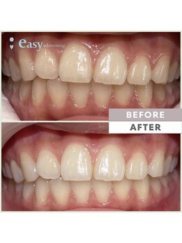 イージーホワイトニング 神戸三宮店(easy whitening)/お客様の症例写真です★