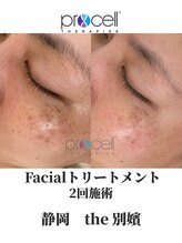 ザ ベッピン(the 別嬪)/シミたるみシワなども改善