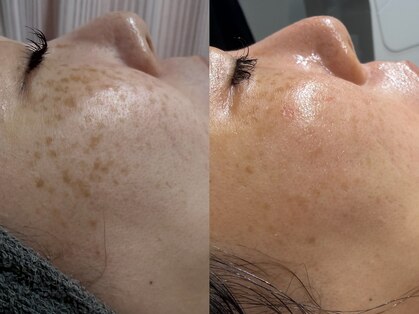 Wax脱毛&毛穴専門店　D-lotusの写真
