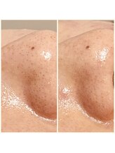 おうちサロン ミキ/鼻の黒ずみに【酸ピーリング】