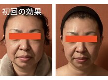 ロイヤリティ(ROYALTY)/たるみケア、毛穴、二重アゴ☆