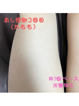 フェリッセ(FELISSE)/あし脱毛 照射3回目【M様】