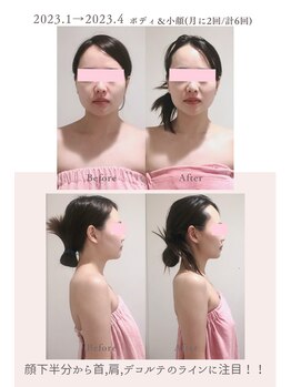 トゥインクル 麻布(twinkle)/麻布十番/シンメトリー小顔矯正