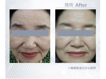 キラディ(KILADY)/憧れの韓国美肌を手に入れる！