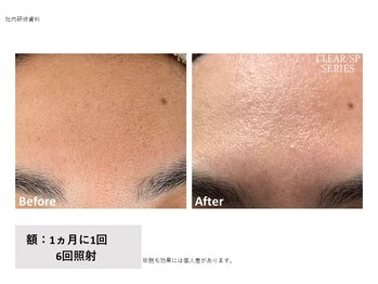 レクリエイター(Re:QREATOR)/セルフ脱毛(before after)