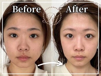R-1ビューティーサロン 銀座/BEFORE＆AFTER　1回目