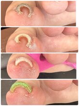 ゾゾ イリプレッセブル(ZOZO irreplaceable)/巻き爪改善