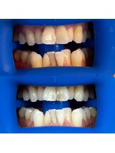 ホワイトニングセンター 富山二口店/富山　二口町ホワイトニング