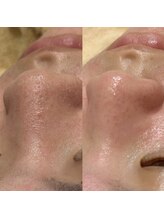 シェリー トウキョウ 西葛西店(Cherie Tokyo)/詰まった角栓が浮き出る◎