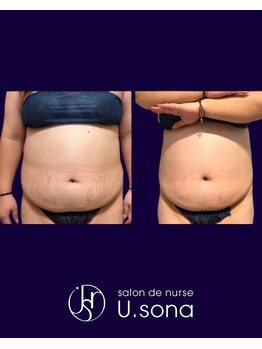 小顔・脂肪コントロール専門 salon de nurse U.sona～松本店～/【痩身】お腹脂肪分解症例