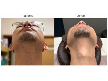 デサフィオ(Desafio.sln)の写真/【結果重視＆濃ゆい毛専門店★】男性もVIO含めた全身まるごとしっかり脱毛可能！満足度◎部分お試し￥1000