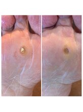 ニコ(niko)/痛い魚の目除去