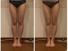 うつくし痩身 美サロン ゼットワン(Z-ONE)/メディセル＋ハンドマッサージ