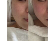 レオティアラ(REOTIARA)の雰囲気（小顔が得意。リフトアップ&うる艶美肌ヒト幹細胞酸素炭酸パック）
