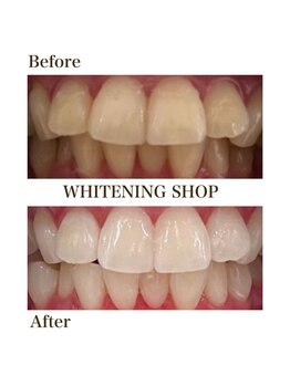 ホワイトニングショップ 恵比寿店/【Before After】フリーパス