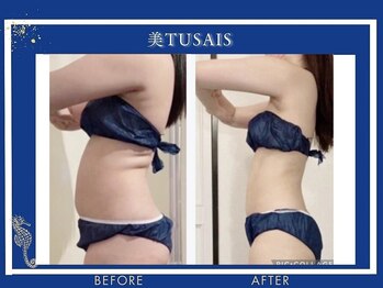 ビテュセスリー はなみずき店(美tusais3)/ウルトラ痩身
