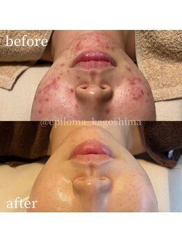 エピロマ(EPILOMA)/鹿児島市/宇宿/肌質改善