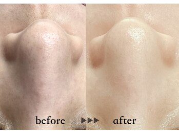 ソーヴ(SOLVE)/マツヤニワックス！1回で美肌に