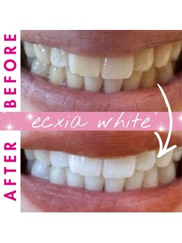 エクシアホワイトニング 西尾店/ビフォーアフター