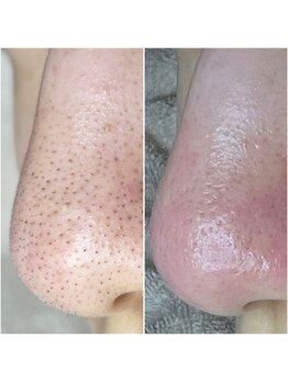 レンリー(Renry)の写真/毛穴の詰まりを放置すると肌トラブルに…専門プロがお悩み解消◎頑固な肌トラブルは当店にお任せください!