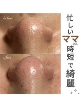 スパークル/毛穴/毛穴洗浄/ワックス